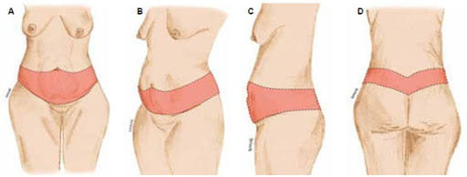 Abdominoplastia 360° graus — descolamento