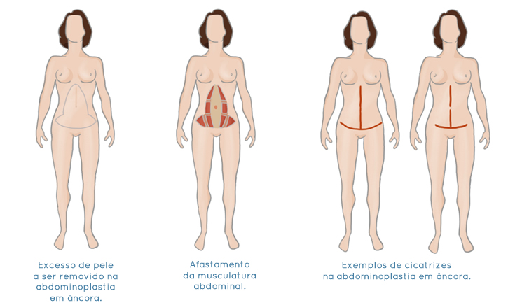 Abdominoplastia em âncora — desenho da cicatriz