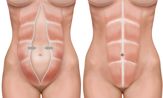 Diástase abdominal