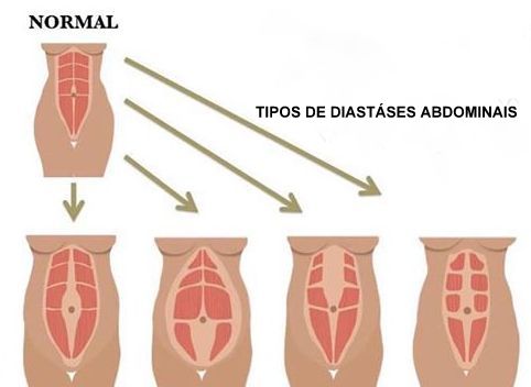 Tipos de diástases abdominais na abdominoplastia