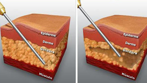 Procedimento lipoaspiração e lipoescultura