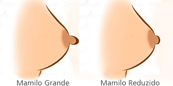 Mamiloplastia — plástica de mamilos
