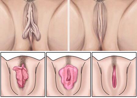 Ninfoplastia
