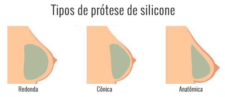 Formatos de prótese de mama